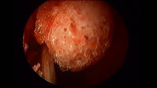 Right prelacrimal approach with septal correction unedited [upl. by Noira99]