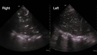 40 yo with rapidly progressive dyspnea No prior medical history [upl. by Rothschild]