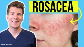 Doctor explains ROSACEA  Skin Condition  Causes Treatment and more [upl. by Ynaffyt]