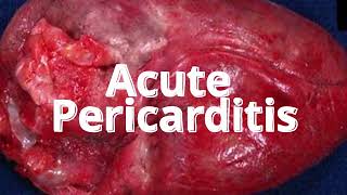 Acute Pericarditis Symptoms Signs Diagnosis Treatment [upl. by Dorcy]