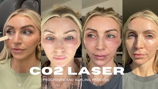 I GOT A CO2 LASER FOR MY UNDER EYE WRINKLES  LOOSE SKIN  is it worth it daily check ins [upl. by Farrish]