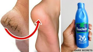 फटी एड़ियों का चमत्कारी घरेलु उपाय  Cracked Heels Home Remedy [upl. by Ahseekal248]