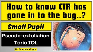 Phaco and Toric IOL in an eye with Pseudoexfoliation and Dense Cataract Dr Deepak Megur [upl. by Norris]