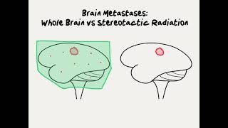 Doctor Explains Whole Brain Radiation versus Stereotactic Radiosurgery for Brain Metastases [upl. by Dewitt]