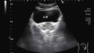 Stone in Ureter with minimum hydronephrosis and hydroureter [upl. by Nirel]