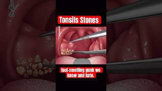 TONSILS STONES TONSILLITIS [upl. by Forbes]