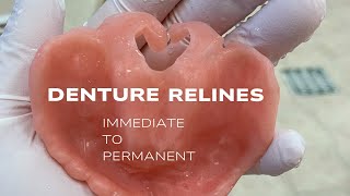 Immediate DenturePermanent Reline [upl. by Elcarim737]