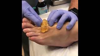 ganglion cyst of foot in this drained out  cyst removal [upl. by Akeihsal974]