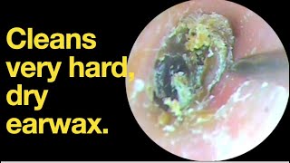 Cleans very hard dry earwax ear wax removal  ear cleaning  ASMR  relaxation  relax [upl. by Ycnaffit294]