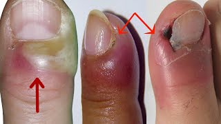 How to Treat Paronychia at Home  Home Treatment for Paronychia Nail Infection [upl. by Platt]