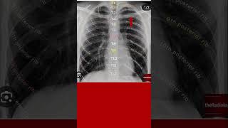 Identify posterior end of rib on chest x ray shorts xray xraymachine chestradiograph [upl. by Elesig]