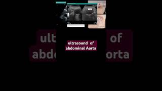 ultrasound of abdominal Aorta [upl. by Aihsele]