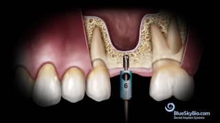 Advanced Simplified Sinus Lift Technique No Probe [upl. by Ammej212]