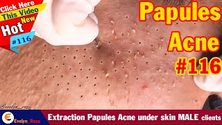 Extraction Papules Acne under skin MALE clients  Acne Treatment 116 [upl. by Kenelm]