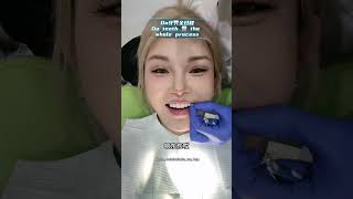 牙齿贴片过程 拥有一口漂亮的好牙🦷整形 医美 牙齿贴片Dental Veneer Process Have a beautiful set of teeth🦷 [upl. by Abas869]