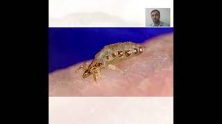 Body Lice Treatment  Symptoms and Causes  Diagnosis  Prevention health [upl. by Heinrike]