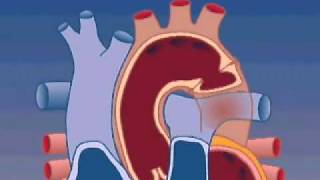 Coarctation of the Aorta [upl. by Roswald315]