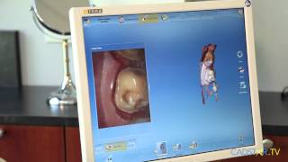 CEREC AC Omnicam Introduction  cadstartv [upl. by Airednaxela]