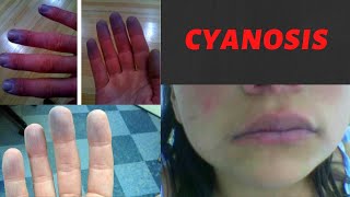 CYANOSIS  Causes Symptoms Types Treatment I What is cyanosis Peripheral and Central Cyanosis [upl. by Eilyac]