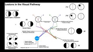 Lesions to the Visual Pathway EXPLAINED [upl. by Ebbie613]