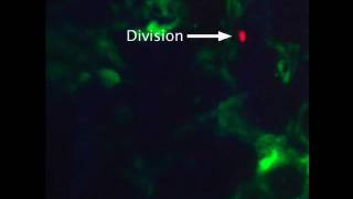 T cell acute lymphoblastic leukaemia TALL cells [upl. by Annoyik359]