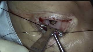 Posterior approach ConjunctivalMullers resection ptosis surgery Putterman procedure [upl. by Early926]