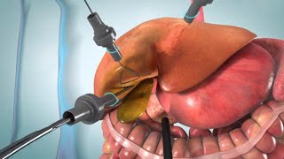 Laparoscopic and open cholecystectomy surgery animation [upl. by Hirsh]