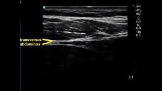 Sonograhic anatomy for abdominal blocks TAP transversalis Quadratus Lumborum blocks [upl. by Willin]