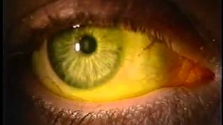 Instilling Fluorescein Dye in the Eye [upl. by Yornek]