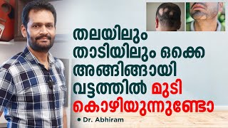 തലയിലും താടിയിലും ഒക്കെ അങ്ങിങ്ങായി വട്ടത്തിൽ മുടി കൊഴിയുന്നുണ്ടോ Alopecia Areata Malayalam [upl. by Yeltrab]