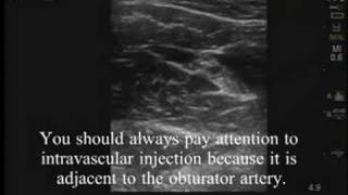 UltrasoundGuided Obturator Nerve Block [upl. by Aneda]