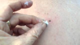 Painless Method to Remove Tick DONT pull it whatever you do [upl. by Aihgn]