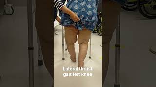 Lateral thrust gait in Genu Varus deformity [upl. by Ednyl]