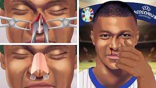 Treating Kylian Mbappés nose injury  Be careful when playing sports [upl. by Gnud]