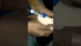 IV Cannulation Technique Porcedure [upl. by Scrivings]