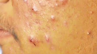 Extraction boutons et drainage le pus suintant dun acné kystique sur le visage  cystic acne [upl. by Aleet]