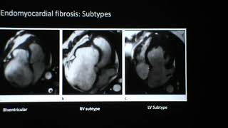 Lecture 7 Diseases of the myocardium Part II [upl. by Bui325]