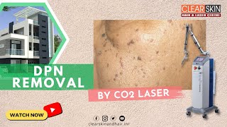 DPN removal Treatment by Co2 laser  Best Laser Removal for Dermatosis Papulosa Nigra  DrKailash [upl. by Inilam]