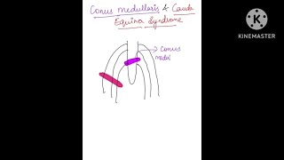 Conus medullaris vs Cauda Equina Syndrome orthopedicsspinalcordinjurymbbsneetpg inicetfmge [upl. by Aurea108]