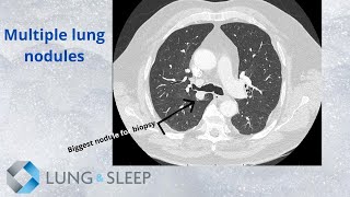 Multiple pulmonary nodules Are they cancer [upl. by Ingrid]