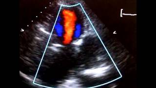 Echocardiogram Pseudoaneurysm Inferolateral LV [upl. by Dannon]