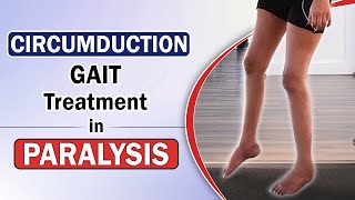 Circumduction Gait Treatment in Paralysis  Paralysis Patient Leg Movement Exercises  SRIAAS [upl. by Kealey]