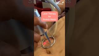 Laser Treatment for Stretch Marks [upl. by Scholz736]