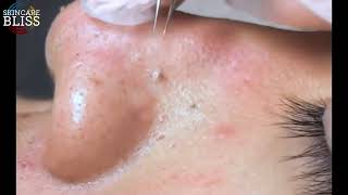 How to Get Rid of Blackheads Easy and Effective Tips [upl. by Orion]