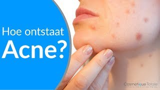 WAT IS ACNE HOE ONTSTAAT ACNE en hoe kan je acne voorkomen [upl. by Mark]