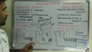 Ameloblastoma management [upl. by Eemia]