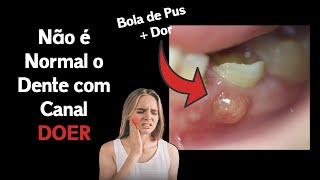 5 Sinais de que o Seu Tratamento de Canal deu MUITO ERRADO [upl. by Naivad465]