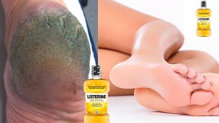 This Listerine amp Vinegar Foot Soak is Magic for Dry Heels GET RID OF DRY SCALY FEET [upl. by Yelssew]