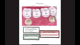 Zahnärztliche Brücken abrechnen  Abrechnung einer Vollkeramikbrücke für GKVPatienten [upl. by Yevad]