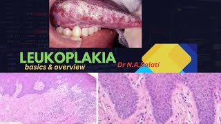 Leukoplakia histopathology [upl. by Ruffin]